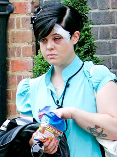 Despite a Black Eye, Kelly Osbourne Says, 'I'm Fine'