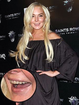 Lindsay Lohan Rotten Teeth Pictures