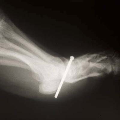x-ray of nail gun injury in foot